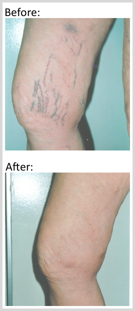 Spider  veins treatment before and after