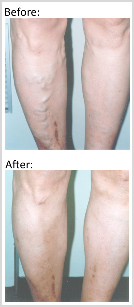 Varicose vein treatment before and after